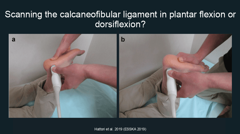 Scanning the calcaneofibular ligament: placing the patient’s ankle in dorsiflexion or plantar flexion?