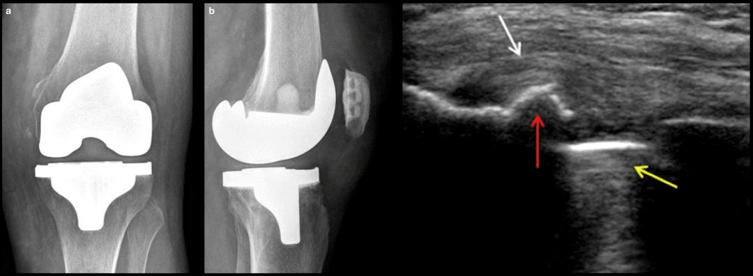 Snapping of the popliteal tendon after total knee arthroplasty