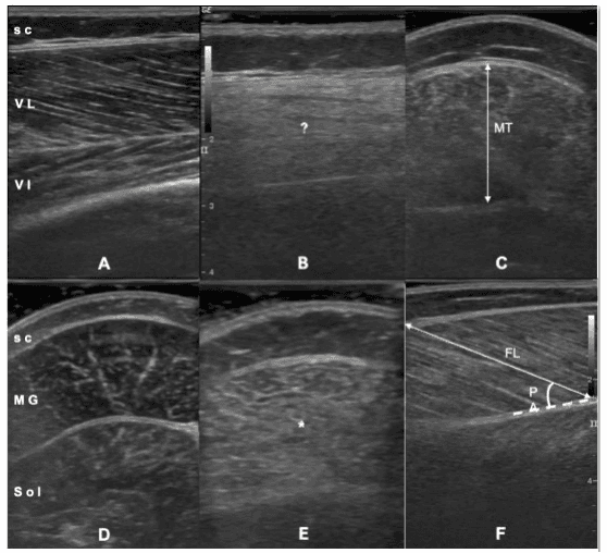 Musculoskeletal Ultrasound: A Guide to Assessing Muscular Dystrophy