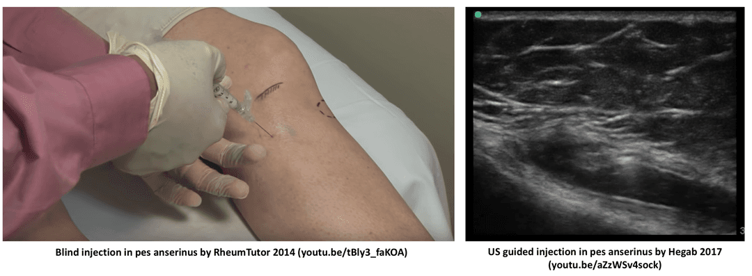 Ultrasound guided injection of the pes anserinus bursa over a blind injection