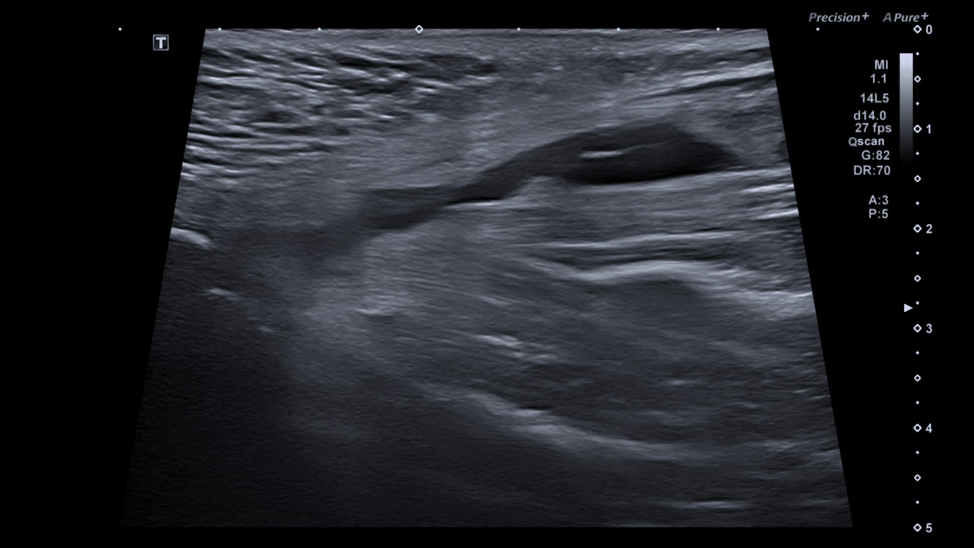 Adductor Longus Muscle Tear