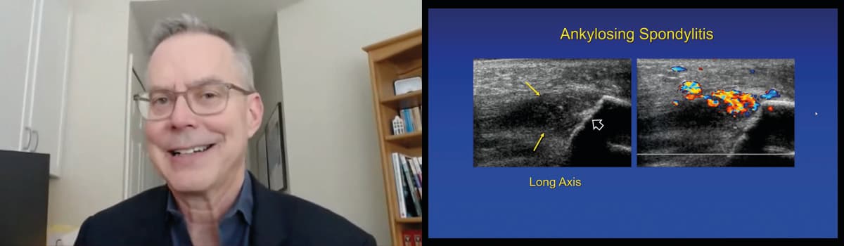 Ultrasound Evaluation of Arthritis