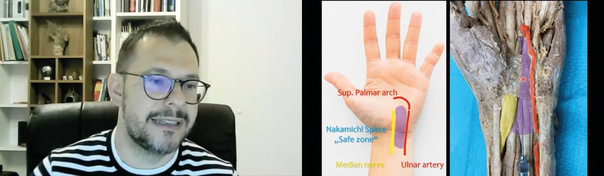 Ultrasound in Carpal Tunnel Syndrome: From diagnose to minimal-invasive release procedures
