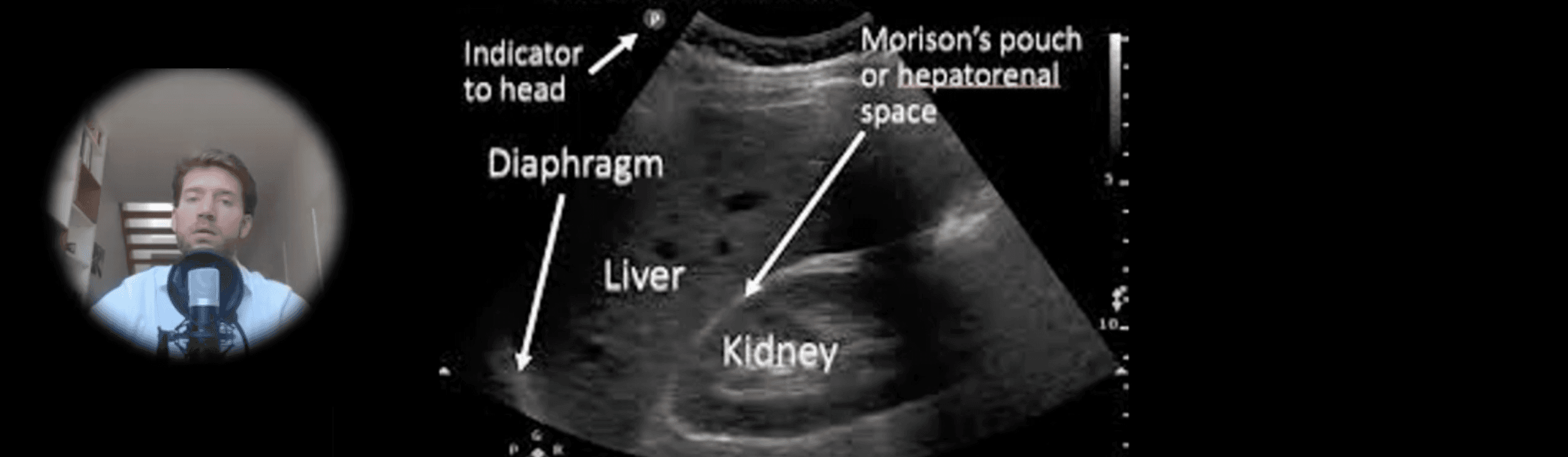 Extended Focused Assessment with Sonography in Trauma: Tips and Tricks