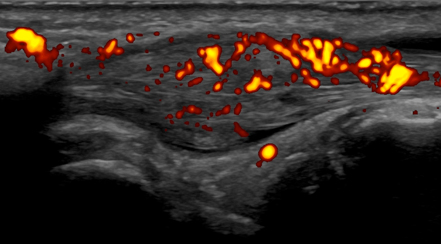 Doppler Imaging of Neovascularization in MSK Ultrasound