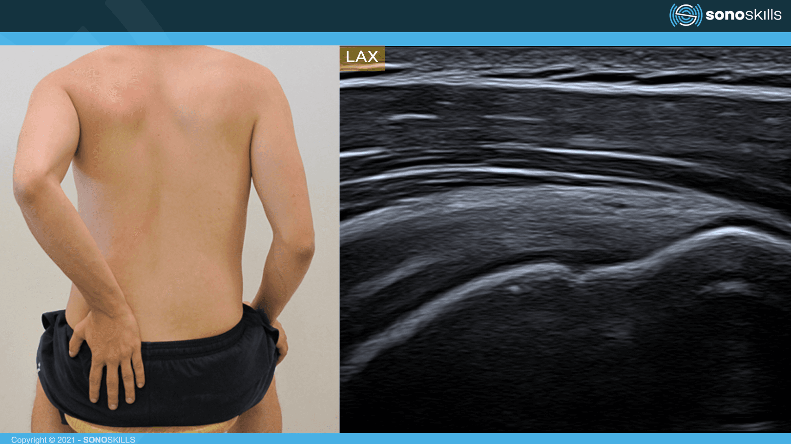 Pain after shoulder surgery: Ultrasound's role in assessing rotator cuff repair and biceps surgery