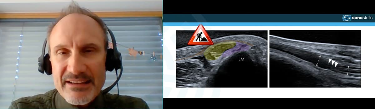 Cubital Tunnel Syndrome: Diagnostics, Pathology and US-guided Tunnel release