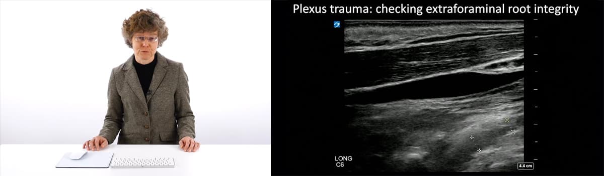 Ultrasound of Traumatic and Iatrogenic Nerve Injuries