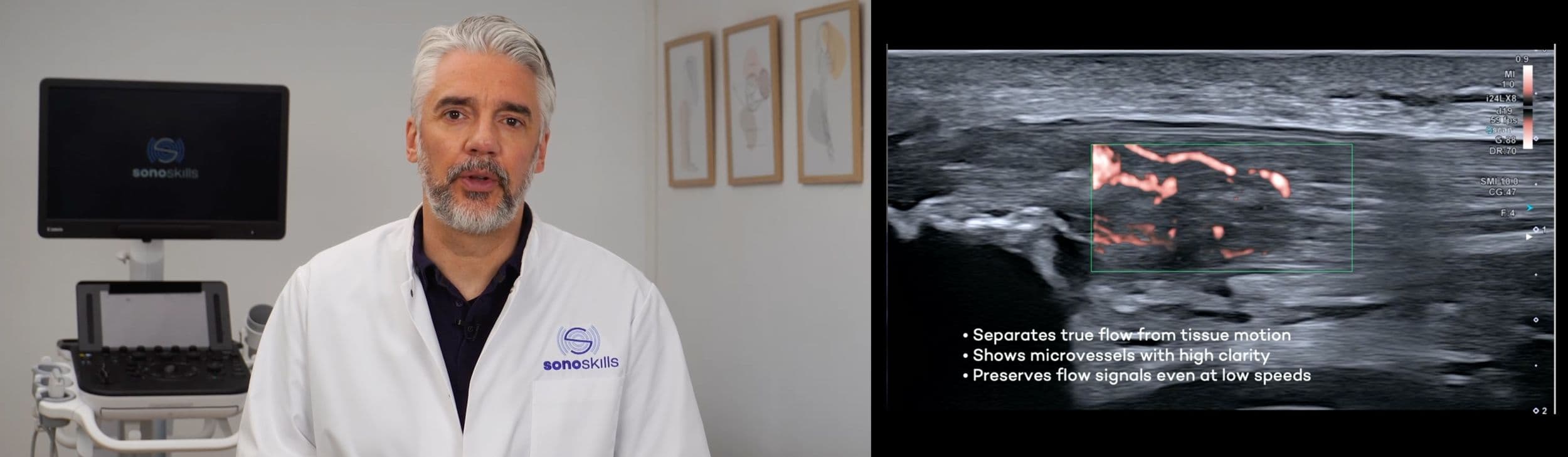 Doppler Imaging of Neovascularization in MSK Ultrasound