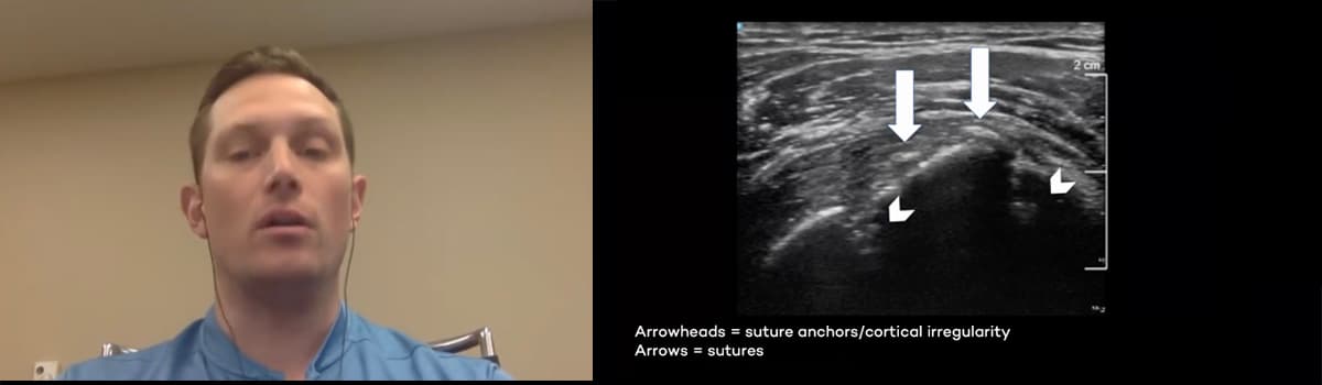 Pain after shoulder surgery: Ultrasound's role in assessing rotator cuff repair and biceps surgery