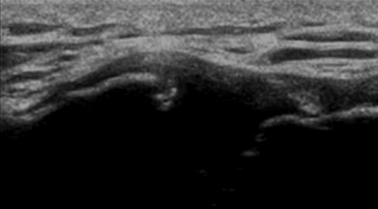 MSK Ultrasound in Psoriatic Arthritis