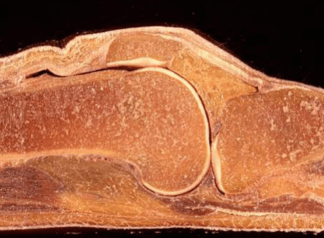 The infrapatellar pad: an article suggestion