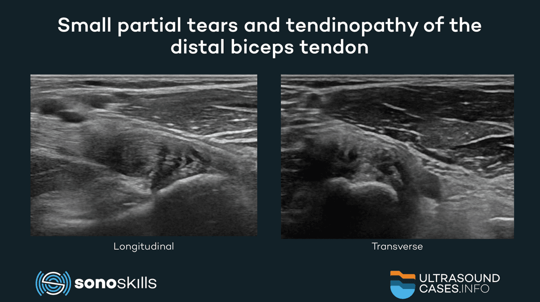 Distal biceps brachii anatomy and the added value of musculoskeletal ultrasound