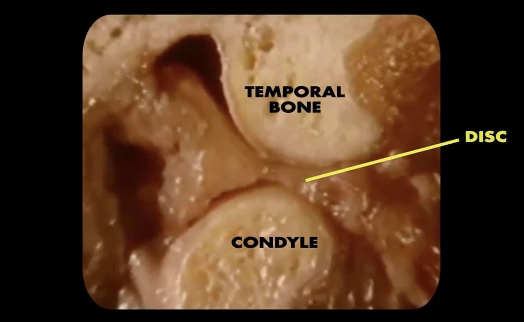 Ultrasound examination of disc displacements in temporomandibular joints
