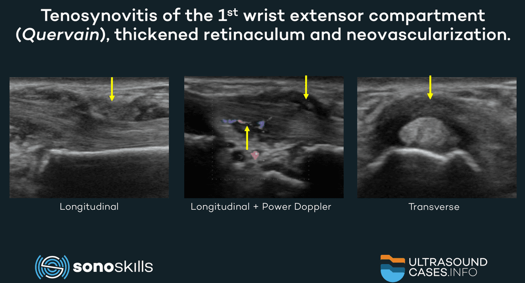 Musculoskeletal ultrasound for diagnostic and interventional purposes in Quervain’s disease