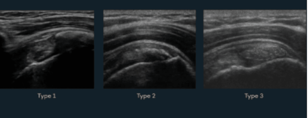 Ultrasound-Guided Barbotage of a Calcification: An Approach to Tendon Health