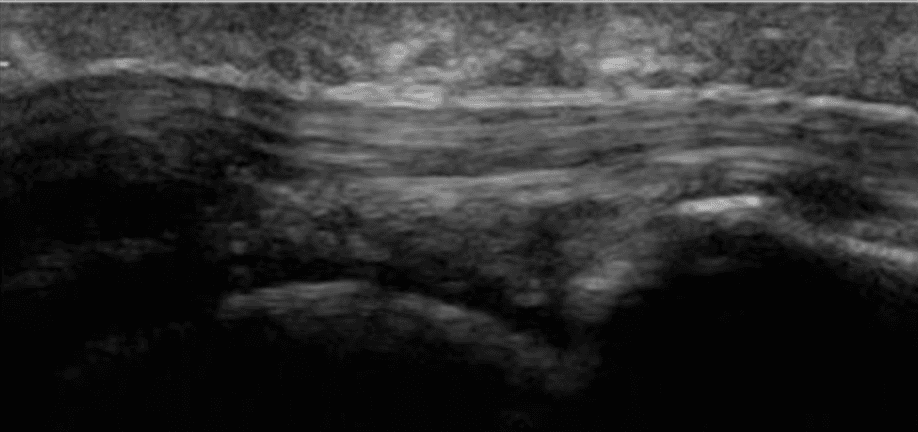 Hallux saltans: the flexor hallucis longus triggering phenomena