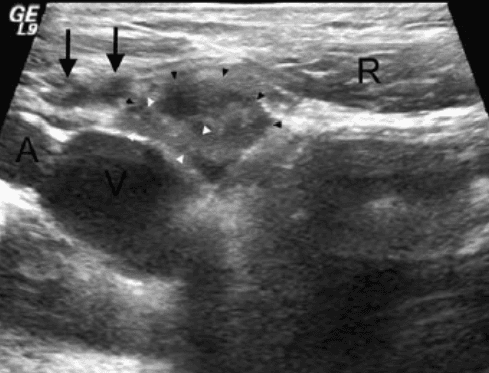 Dynamic ultrasound evaluation of the inguinal hernia