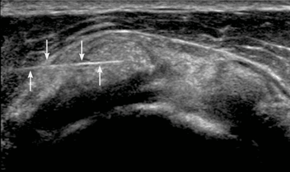 Ultrasound guided barbotage of calcific tendinitis of the rotator cuff