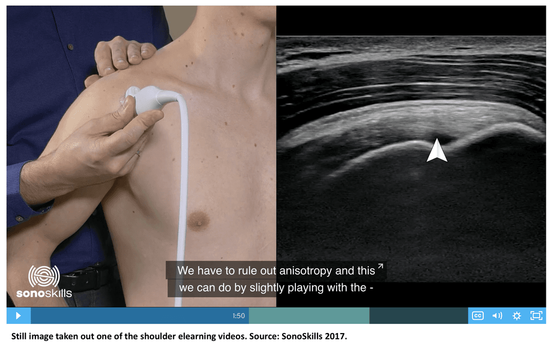Orthopedic surgeons increasingly use ultrasound for preoperative planning