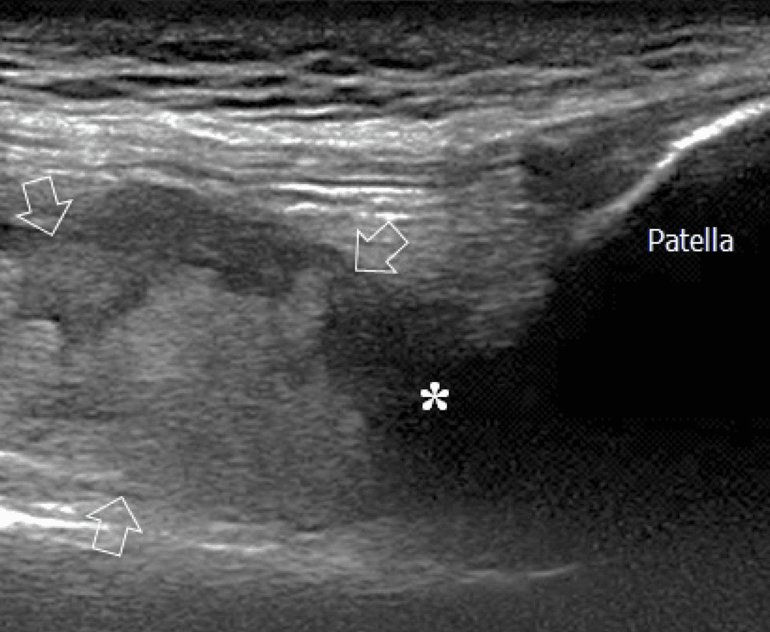 Point of care ultrasound in detecting haemophilia