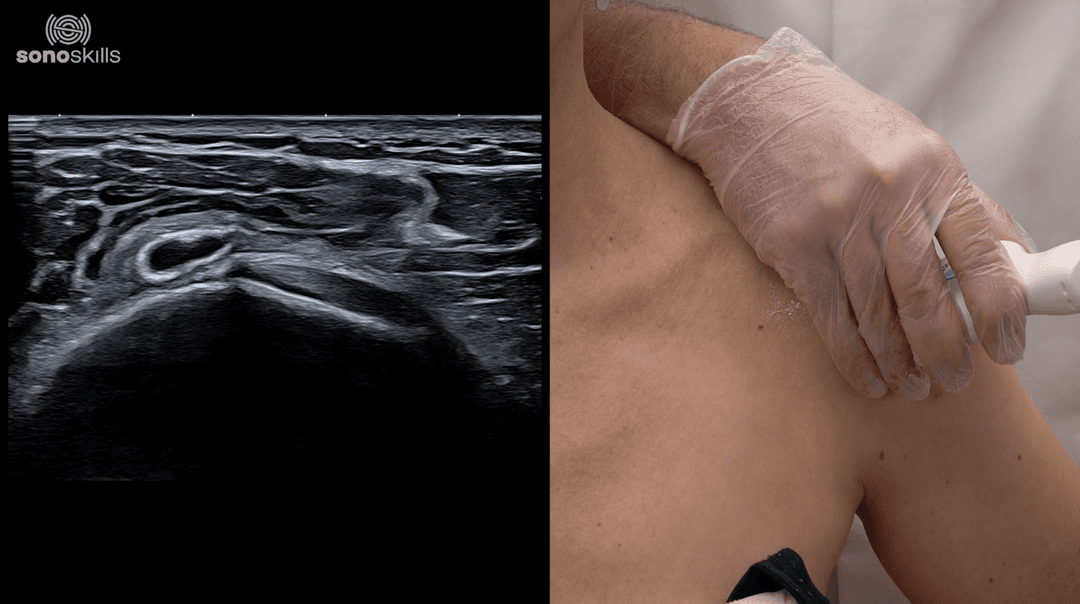 Shoulder Case: Calcification Migration