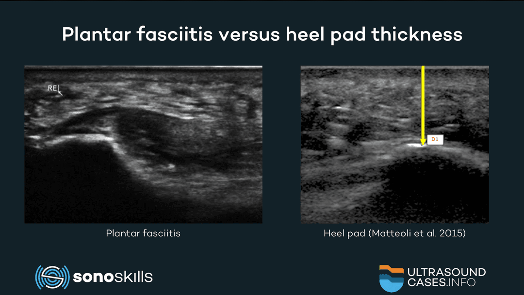 Measuring heel fat pad thickness in patients with plantar fasciitis