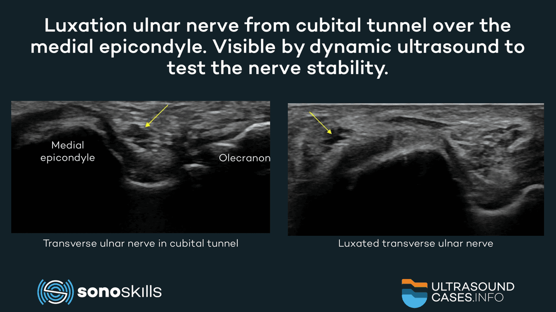 Using dynamic musculoskeletal sonography to assess the cubital tunnel for an ulnar nerve instability