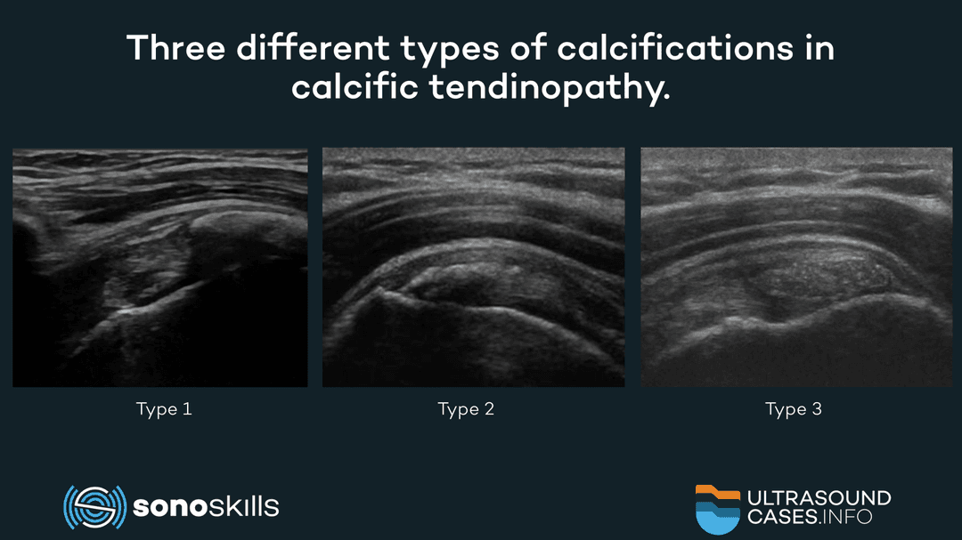 The three types of calcifications in calcific tendinopathy