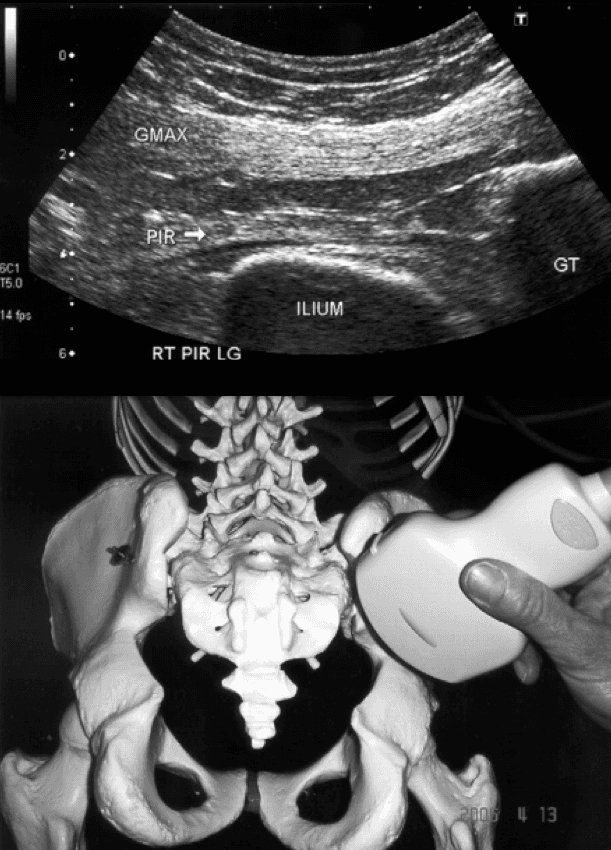 Ultrasound-guided piriformis muscle injection: technical guideline