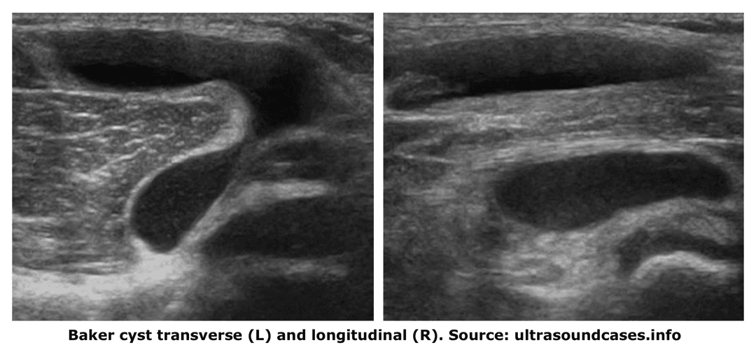 The Baker cyst: a bursa, a recess or a true cyst?