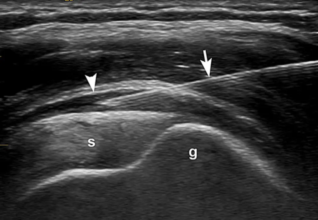 Ultrasound guided injection of the supraspinatus tendon or bursa SASD