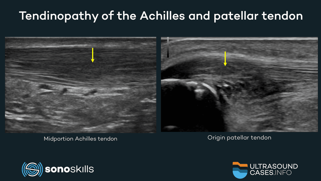To image, or not to image, Achilles or patellar tendinopathy