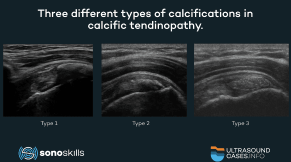 Calcific tendinopathy: a summary from recent literature