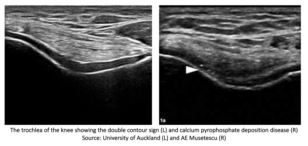 Double contour sign, pyrophosphate deposition disease or anisotropy