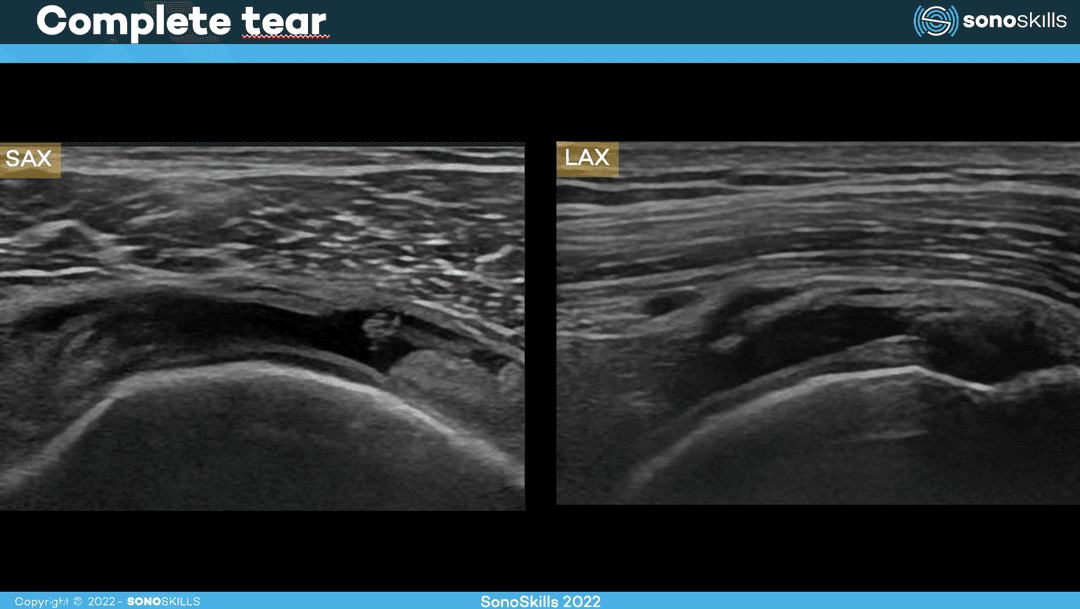 Identifying Common MSK Ultrasound Pathologies