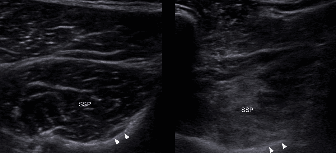 The Role of Musculoskeletal Ultrasound in Geriatric Orthopedics