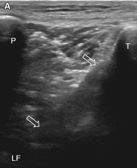 Examining anterior cruciate ligament injury with ultrasound