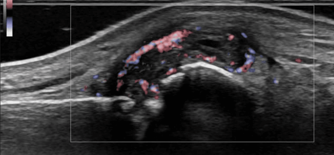 Musculoskeletal Ultrasound in the Diagnosis of Rheumatoid Arthritis