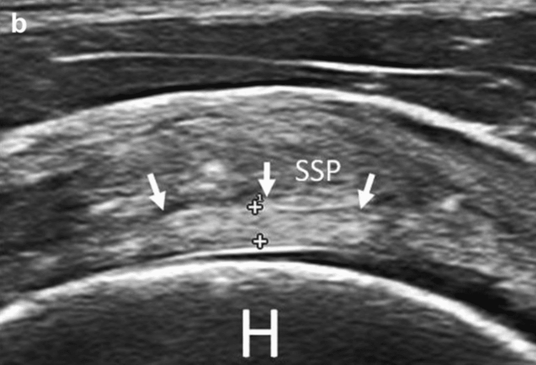 The rotator cable: relatively unknown anatomical structure of the shoulder