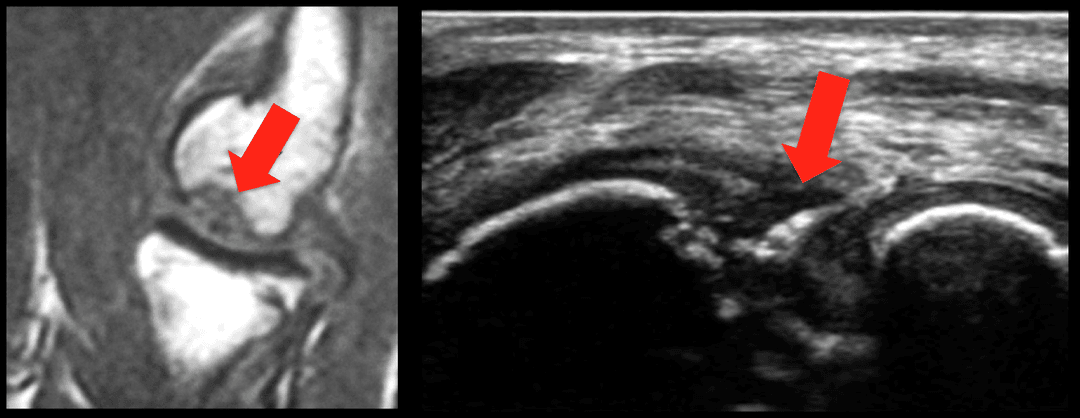 Elbow ultrasound of capitellar osteochondritis dissecans