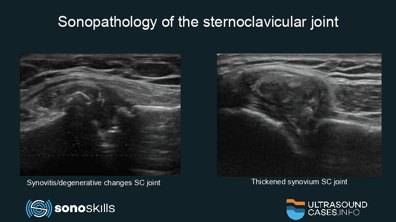 Sonopathology of the sternoclavicular joint