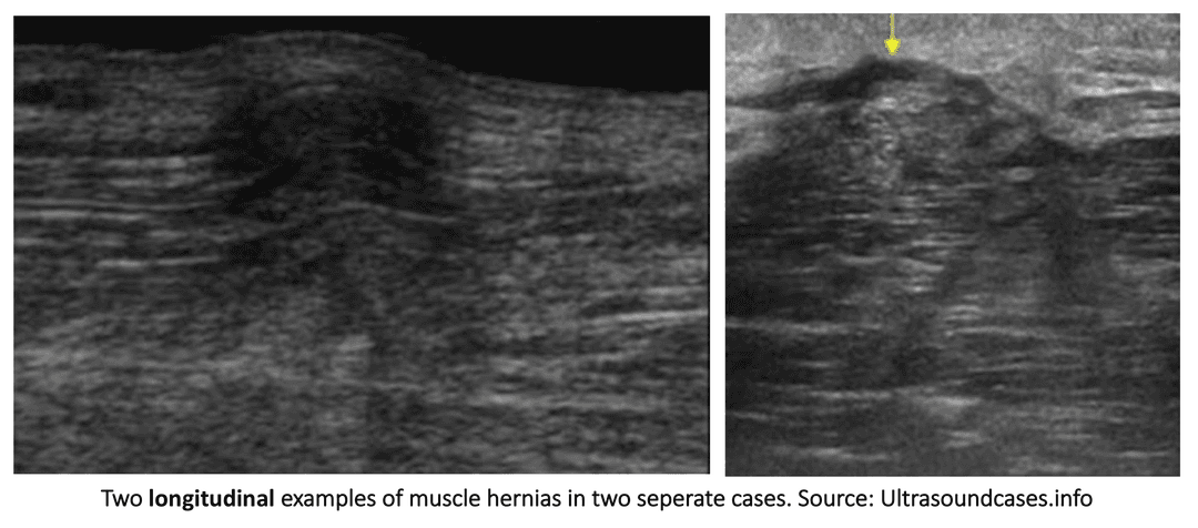 Muscle herniation: explanation and ultrasound assessment