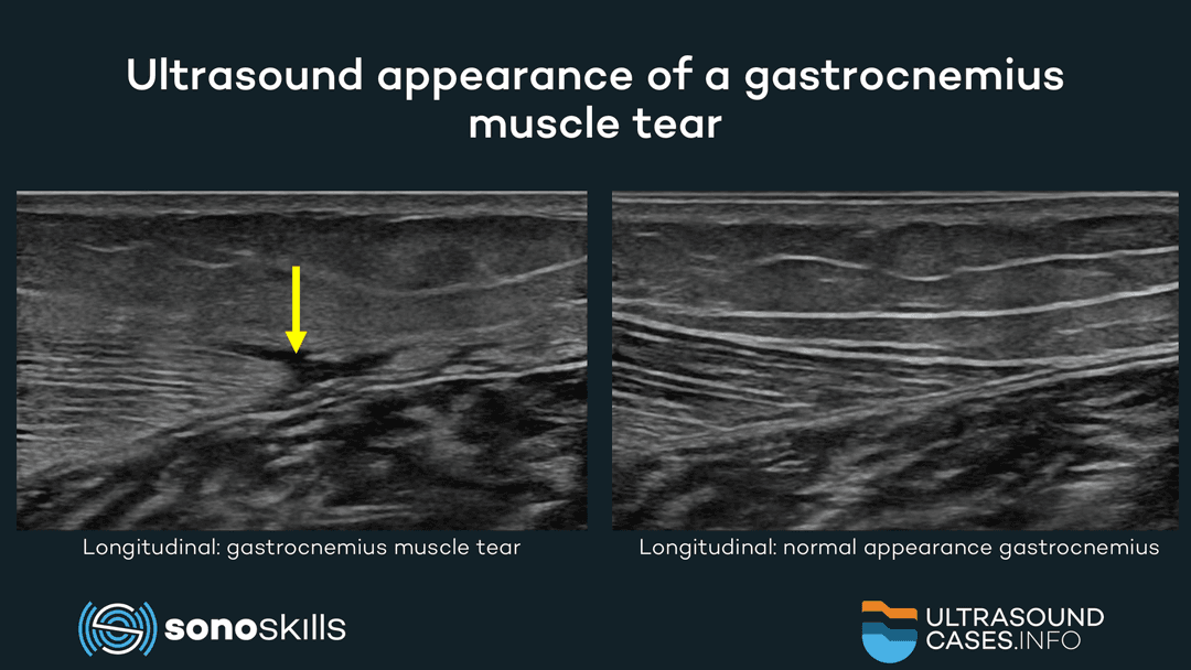 Musculoskeletal ultrasound of calf injuries