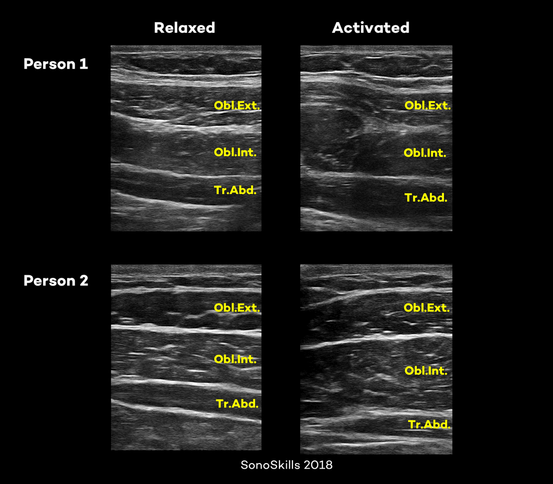 The functional activation ratio to assess the transverse abdominus muscle with ultrasound