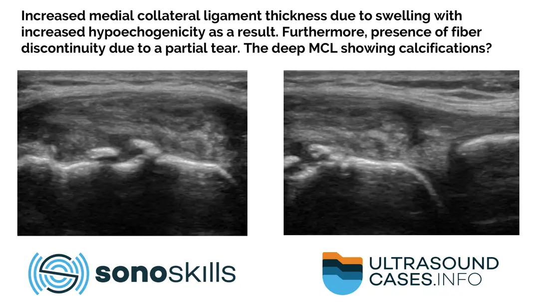 The added value of MSK ultrasound in medial collateral ligament injury