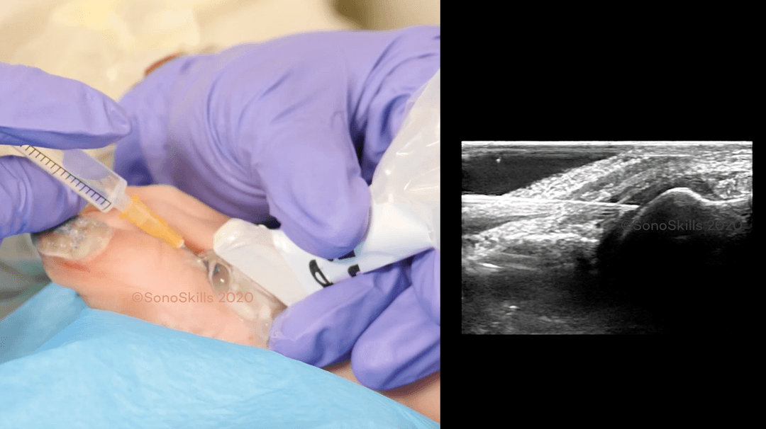 Ultrasound guided joint injections of the First Metatarsophalangeal Joint
