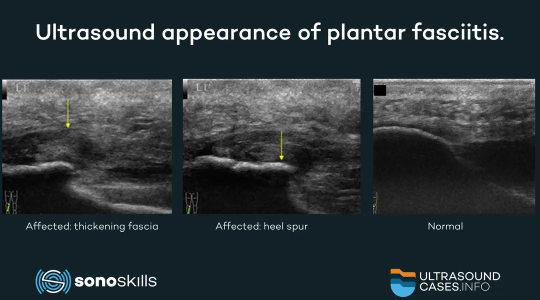 Comparing ultrasound with MRI and CT in measuring the plantar fascia