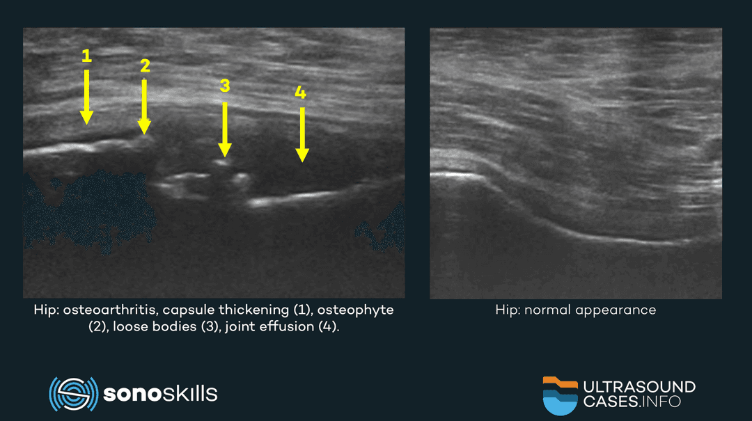 Musculoskeletal ultrasound of the hip joint, soft tissues and nerves
