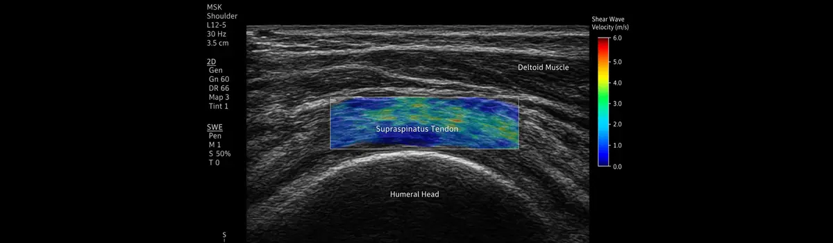 The Next Dimension in Tendon Imaging: Shear Wave Elastography in Musculoskeletal Ultrasound